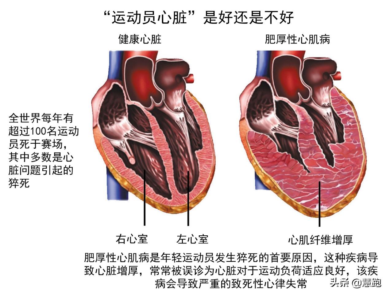 最新猝死现象，背后的原因与应对策略探讨